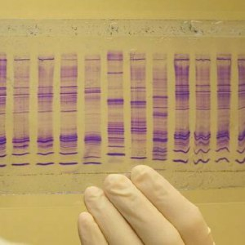 Biopsia e lëngshme: Diagnozë e tumoreve përmes pështymës
