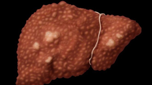Vdekshmëria nga hepatiti viral barazohet me atë nga Aids