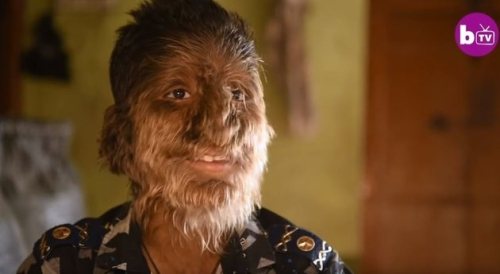 Djali indian me "Sindromën e Volframit" (Video)