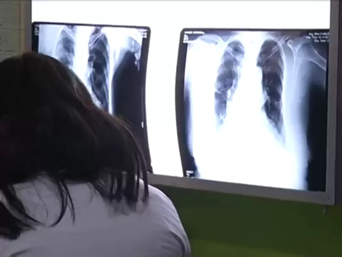 Shfaqet tuberkulozi në Durrës